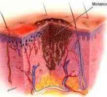Cum este diagnosticul diferențial al melanomului