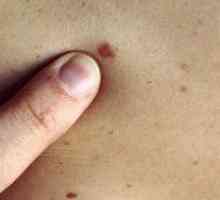 Cum recunoști un melanom într-un stadiu incipient