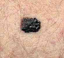 Cum recunoști un melanom: simptome si metode de diagnostic