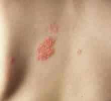 Cum de a recunoaște un herpes zoster la oameni: boala si tratamentul acesteia în fotografii