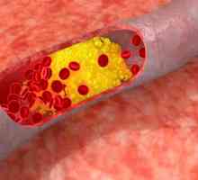 Cum de a reduce nivelul colesterolului din sânge (colesterol rata pentru femei și bărbați)