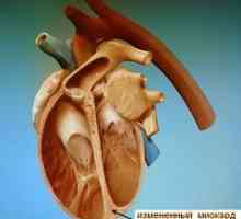 Cardiomiopatie