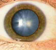 Cataracta - una dintre cele mai comune boli de ochi
