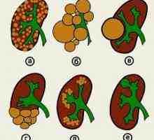 Chist renal