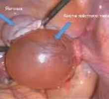 Corpus luteum chist in timpul sarcinii, cauze, tratament