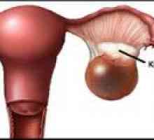 Cystoma (dreapta, stânga) - Ovar cauze, tratament