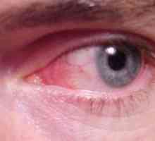 Conjunctivită sau roșu ochi: simptome, tratament