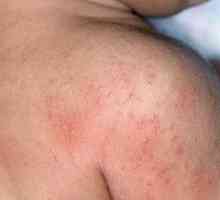 Alergii ale pielii: cauze, simptome, tratament