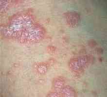 Lichen planus: simptome și cauzele tumorilor