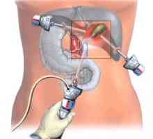 Laparoscopia vezicii biliare: operația trece