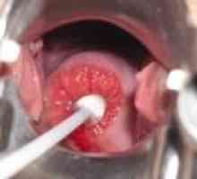 Tratamentul cu laser de eroziune de col uterin