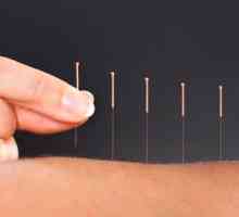 Acupunctura: Adevaruri si mituri