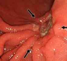 Ulcerul Duodenal Tratamentul
