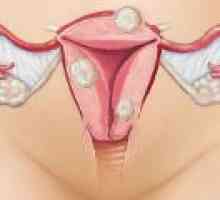 Tratamentul fibrom uterin, fara interventie chirurgicala