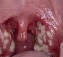 Tratamentul Staphylococcus gât la adulți, la copii