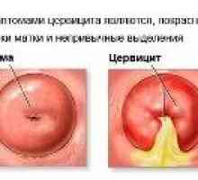 Tratamentul de inflamație de col uterin