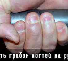 Fungus unghiilor trata pe mâini