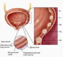 Leucoplakia a vezicii urinare
