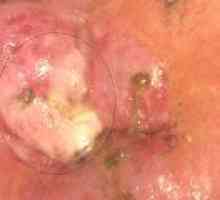 Cervicale leucoplazie: Simptome, cauze si tratament
