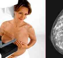 San mamografie