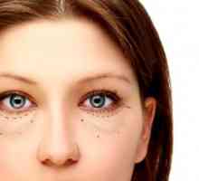 Pungile de sub ochi: cauze si tratament