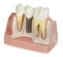 Implanturi dentare Metode