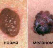 Metodele utilizate pentru tratamentul melanomului