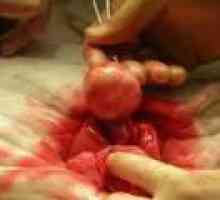 Fibromul uterin dimensiuni mici - cauze, tratament