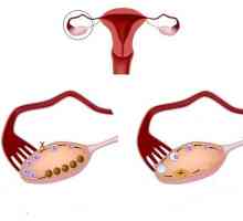 Ovare Multifollikulyarnye. tratament