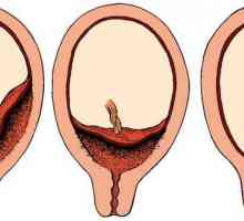 Violarea utero fluxul de sange placentar si alte probleme cu placenta
