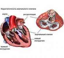 Insuficiența valvei aortice