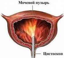 Vezica urinara neurogena