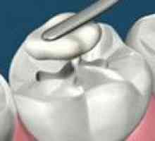 Materiale neobișnuite pentru etanșări vor lupta cariilor dentare