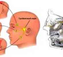 Nevralgia nervului facial: simptome, tratament