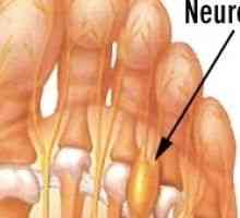 Morton Neuroma (picior in gat) - cauze, simptome și tratament