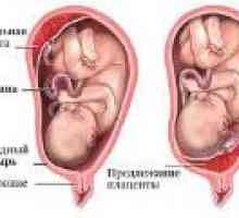 Placentation scăzut în timpul sarcinii, ce este?