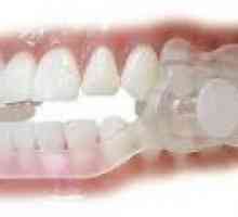 Scrâșnirea dinților de noapte - cauze, tratament