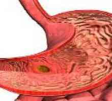 Focal gastrita atrofică: Cauze, simptome, tratament