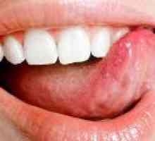 Amorțeală a limbii, cauze, tratament