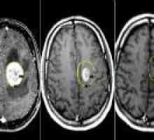 Brain tumorii - cauze, simptome, tratament