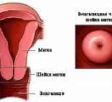 Ptoza colului uterin, simptome, tratament