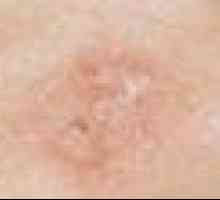 Caracteristici principale melanomul și metode de tratare
