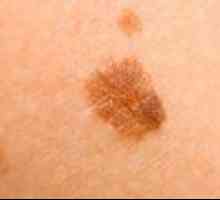 Principalele caracteristici și metode de tratament al melanomului multiplu