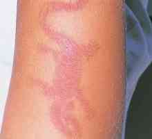 Proprietăți manifestări alergice ale dermatitei