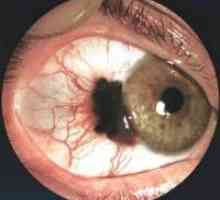 Diagnosticul și tratamentul melanomului ochi