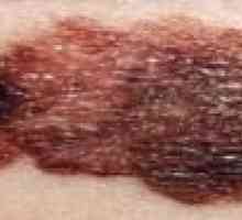 Caracteristici și tratamentul formelor diseminate de melanom