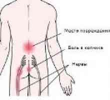 Osteochondrosis sacrală - simptome, tratament