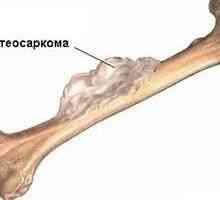 Osteosarcom (sarcomul osteogenic) - cauze, simptome, diagnostic și tratament