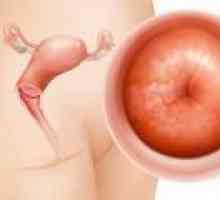 Papilloma de col uterin, cauze, simptome și tratament