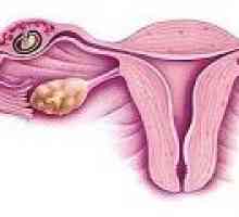 Persistența folicul ovarian - cauze, simptome, tratament